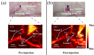 Label-free photoacoustic imaging guided sclerotherapy for vascular malformations: a feasibility study