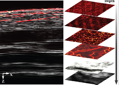 Photoacoustic and ultrasound (PAUS) dermoscope with high sensitivity and penetration depth by using a bimorph transducer