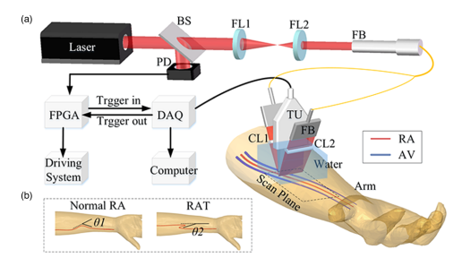 Stereoscopic photoacoustic imaging of radial artery for preoperative evaluation of coronary intervention