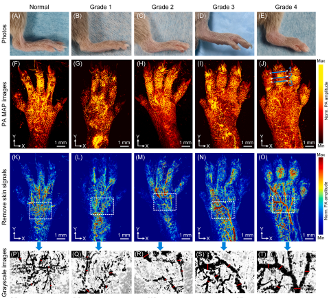Photoacoustic/ultrasonic dual-mode imaging for monitoring angiogenesis  and synovial erosion in rheumatoid arthritis