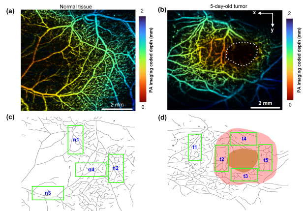 Photoacoustic imaging of tumor vascular involvement and surgical margin pathology for feedback-guided intraoperative tumor resection