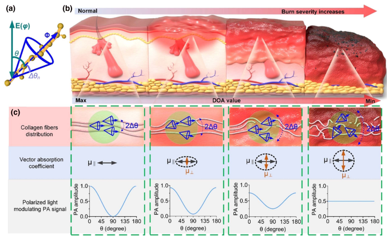 Collagen fiber anisotropy characterization by polarized photoacoustic imaging for just-in-time quantitative evaluation of burn severity